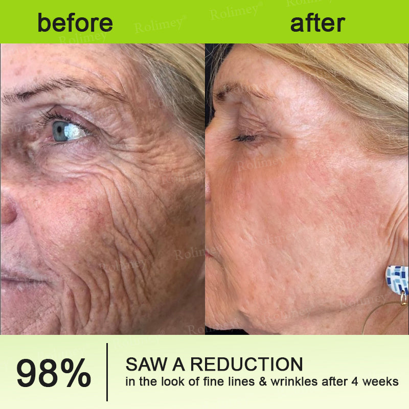 🌾LAST DAY 50% OFF- 💖Rolimey® Botox & Vita A Retinol Shot Wrinkle - Lift Tightening cream