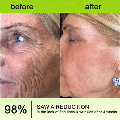 🌾LAST DAY 50% OFF- 💖Rolimey® Botox & Vita A Retinol Shot Wrinkle - Lift Tightening cream