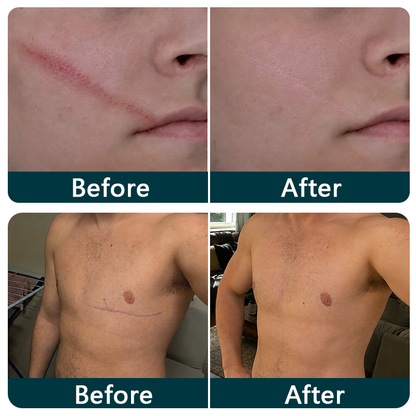 ✨💯® SILICONE SCAR THERAPY ROLL Help Soften, Flatten & Improve the Appearance of Raised Scars