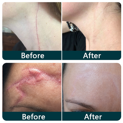 ✨💯® SILICONE SCAR THERAPY ROLL Help Soften, Flatten & Improve the Appearance of Raised Scars