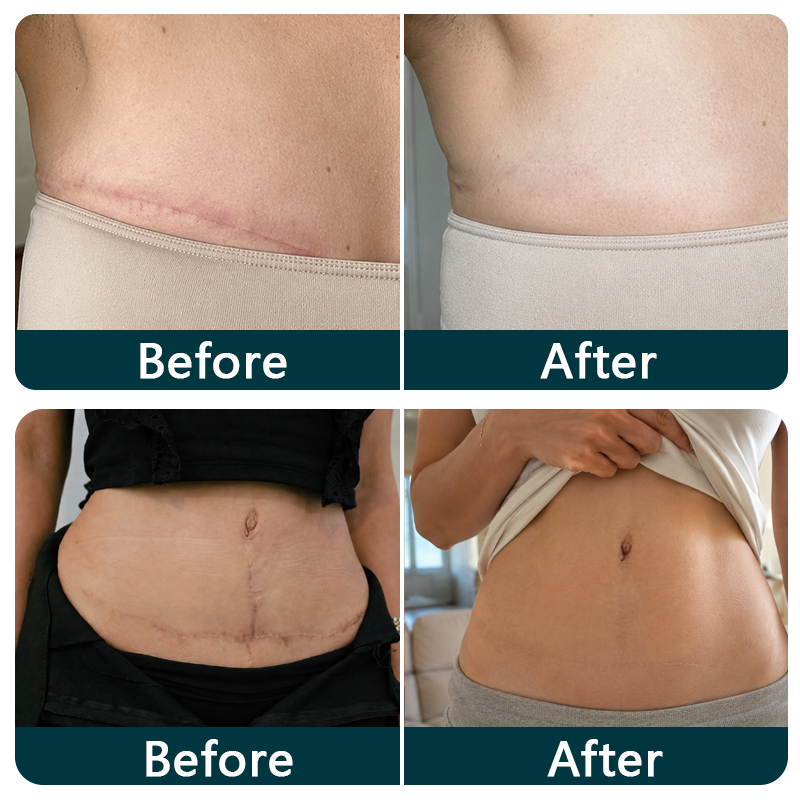 ✨💯® SILICONE SCAR THERAPY ROLL Help Soften, Flatten & Improve the Appearance of Raised Scars
