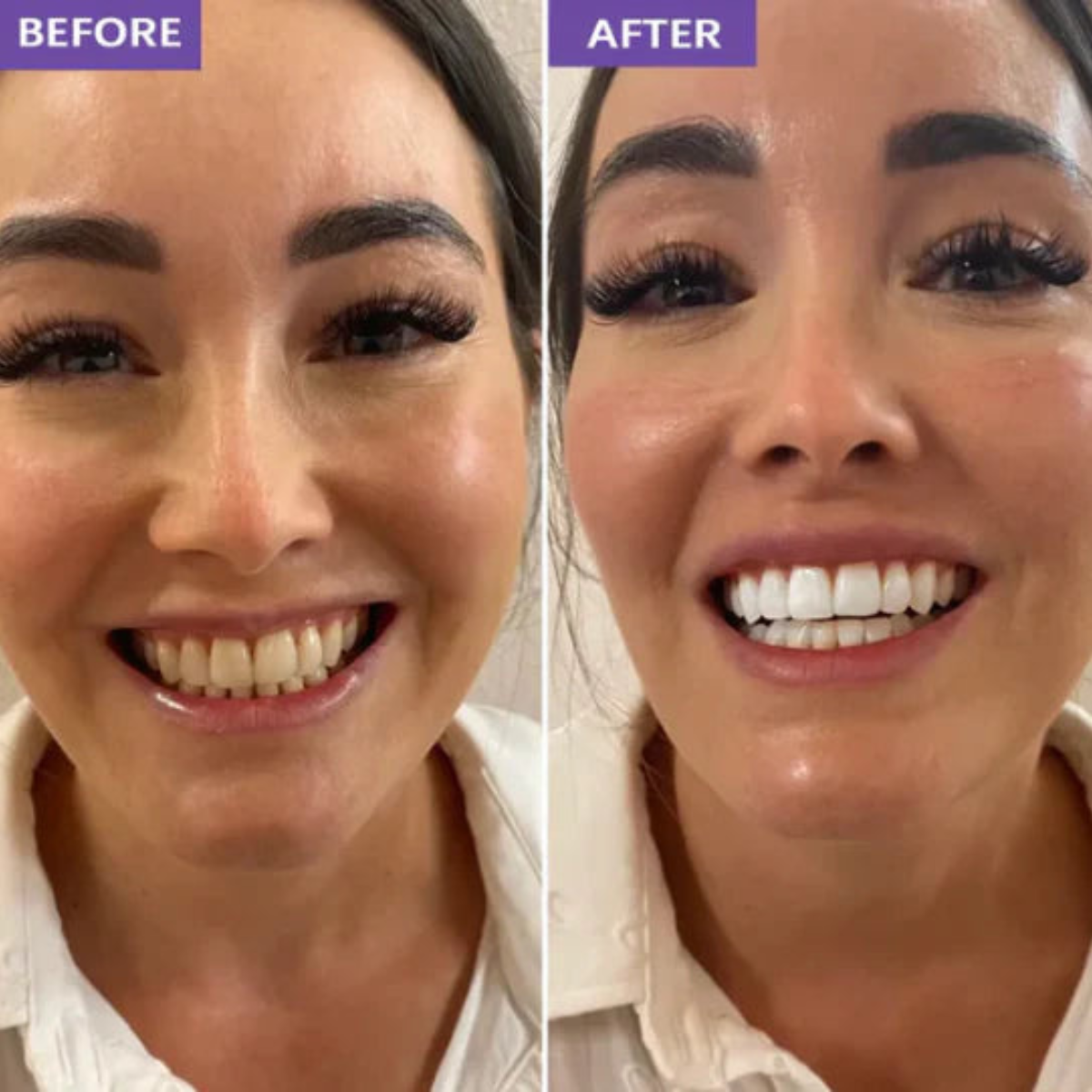 Furzero® - Purple Tooth Whitening Strips
