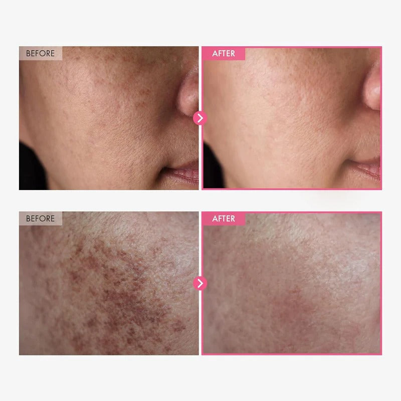 🎁💞LAST DAY 50% OFF-✨Arbutin 7% + Tranexamic Acid 4% Cream